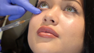 Are Under Eye Fillers in Dubai Quick Procedures?
