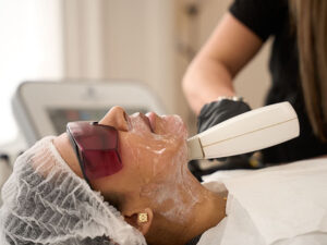Fractional Laser Treatment in London: Modern Skin Resurfacing for Smoother Texture