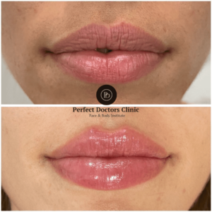 Why Juvederm in Dubai is Perfect for Busy Professionals