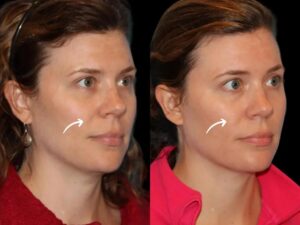 Sculptra Fillers in Dubai for SPF Damaged Skin