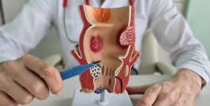 Is Piles Laser Treatment in Mumbai the Right Choice? What Patients Should Know Before Deciding 1 Is Piles Laser Treatment in Mumbai the Right Choice? What Patients Should Know Before Deciding
