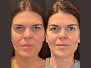 Why International Patients Trust the Best Plastic Surgeons in dubai for Thread Lift 1 Why International Patients Trust the Best Plastic Surgeons in dubai for Thread Lift