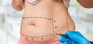Areas Commonly Treated with Liposuction Dubai 1 Areas Commonly Treated with Liposuction Dubai