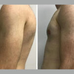 h9 gynecomastia