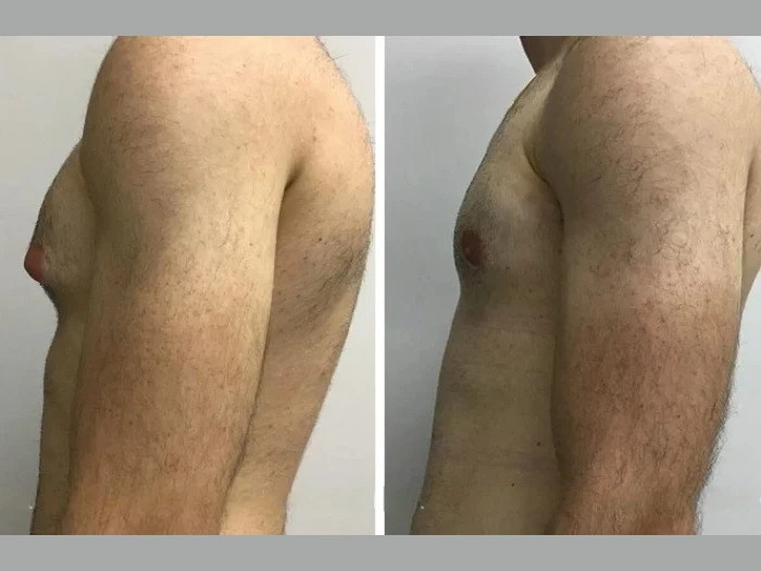 h9 gynecomastia