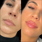 Russian Lip Fillers Treatment in Dubai for a Youthful Lip Appearance 3 Russian Lip Fillers Treatment in Dubai for a Youthful Lip Appearance