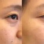 Pigmentation in Riyadh