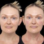 H5 Under eye fillers images