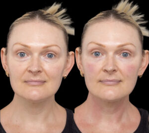 Best Aesthetic Clinic in Dubai for Complete Under Eye Fillers Rejuvenation