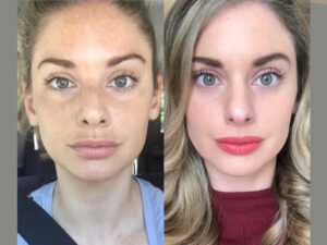 Radiofrequency (RF) Microneedling for Acne Scar Repair by the Best Aesthetic Clinic in Dubai