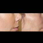 H4 fractional rf microneedling