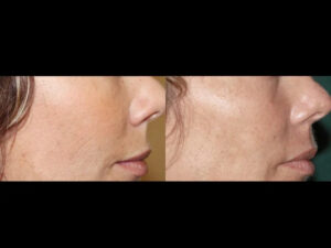 Best Aesthetic Clinic in Dubai for Comprehensive Fractional RF Microneedling Care