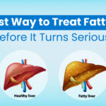 The Best Way to Treat Fatty Liver Before It Turns Serious