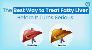 The Best Way to Treat Fatty Liver Before It Turns Serious 1 The Best Way to Treat Fatty Liver Before It Turns Serious