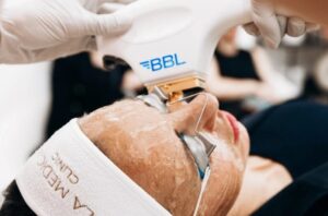 Redness & Broken Capillaries? Try BBL Laser in Manchester