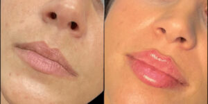 Russian Lip Fillers in Dubai for Smooth Lip Texture and Contour
