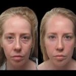 under eye fillers 3 1