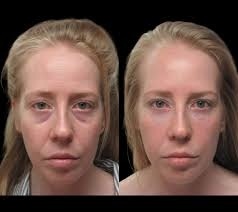 Everything You Need to Know About Under Eye Fillers in Dubai