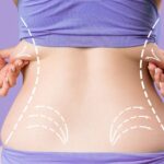 How to Maintain Liposuction Results for the Long Term
