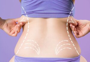 How to Maintain Liposuction Results for the Long Term
