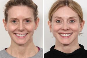 Thread Lift for Busy Lifestyle by the Best Plastic Surgeon in Dubai