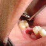 Wisdom Tooth Extraction and Proper Mouth Care