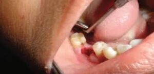 Wisdom Tooth Extraction and Proper Mouth Care