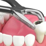 How Are Tooth Extraction Costs Calculated by Dubai Dentists?