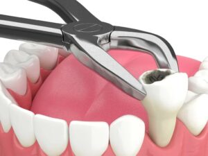 How Are Tooth Extraction Costs Calculated by Dubai Dentists?