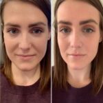 PRP Treatments in Dubai for Natural Hair Regrowth