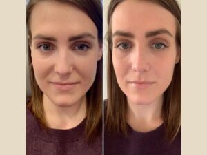 PRP Treatments in Dubai for Natural Hair Regrowth