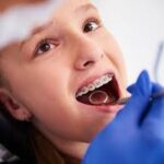When to Consider Invisalign vs. Traditional Braces