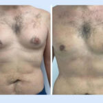 Who Is the Ideal Candidate for Gynecomastia Surgery in Dubai
