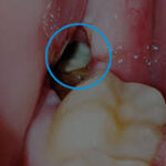 Preventing Complications After Wisdom Teeth Surgery