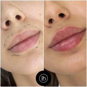 Juvederm Lip Contouring by the Best Doctors in Dubai