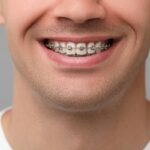 Teeth Braces Cost