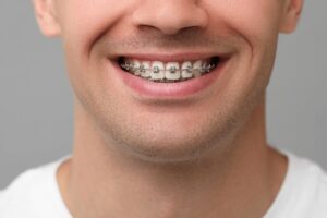 Teeth Braces Cost Based on Different Types of Braces