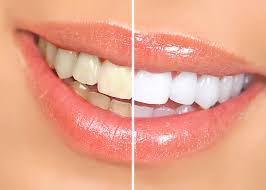 How to Avoid Common Teeth Whitening Mistakes