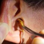 EAR WAX