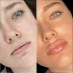 Enhancing Facial Features with Fillers in Dubai 3 Enhancing Facial Features with Fillers in Dubai