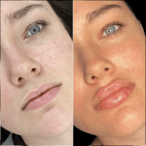 Enhancing Facial Features with Fillers in Dubai
