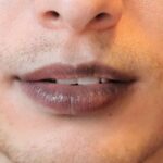Why Laser Treatment Works for Hyperpigmented Lips