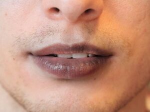 Why Laser Treatment Works for Hyperpigmented Lips 1 Why Laser Treatment Works for Hyperpigmented Lips
