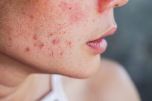Best Acne Treatment in Dubai for Clear and Healthy Skin