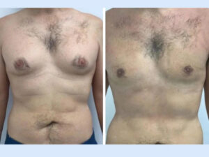 How Modern Technology Is Changing Gynecomastia in Dubai Treatments