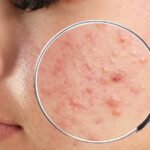 Acne Treatment in Riyadh