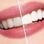 Best Teeth Whitening in Dubai for Pure Fresh White Results 3 Best Teeth Whitening in Dubai for Pure Fresh White Results