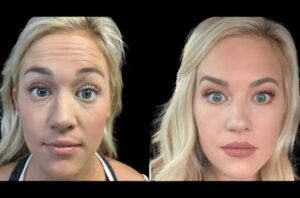 Safety Standards and Regulations for Botox Treatment in Dubai Explained