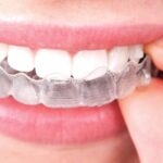 Dental Aligners in Dubai 14