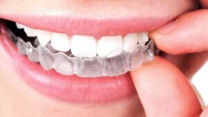 Affordable Dental Aligners in Dubai: Budget-Friendly Options